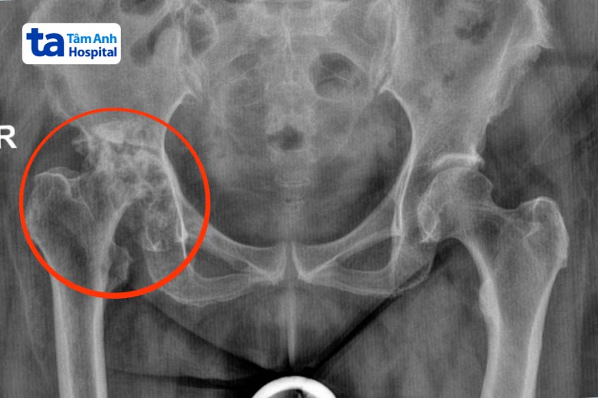 khớp háng bên phải của chị trinh bị biến dạng