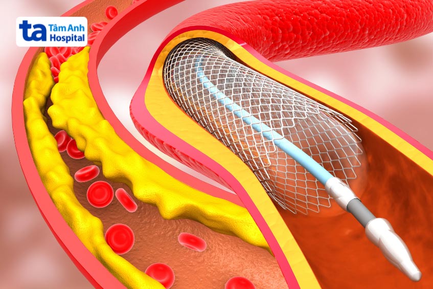 Kỹ thuật đặt stent nong mạch để ngăn ngừa tắc nghẽn
