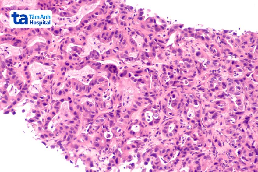 kỹ thuật siêu âm sinh thiết gan