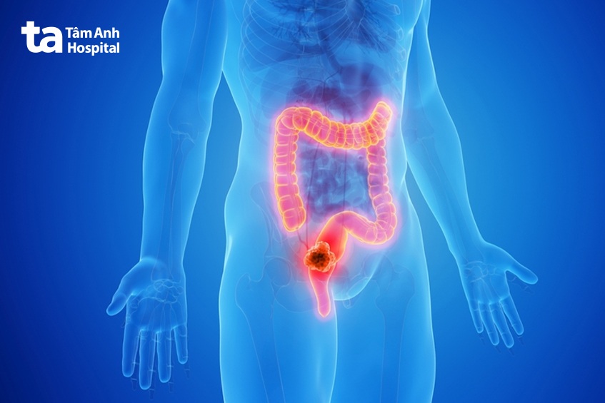 lạc quan khi điều trị ung thư trực tràng 