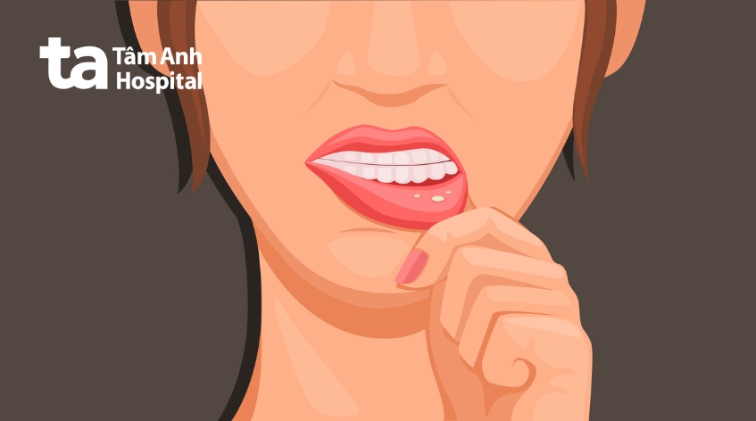 Loét miệng do hóa trị