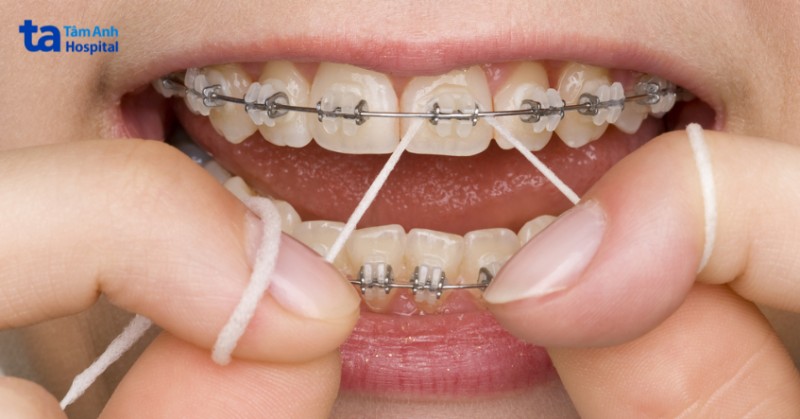 Bọc răng sứ, niềng răng làm tăng nguy cơ mắc hôi miệng