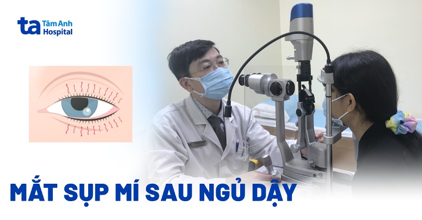 Mắt bị sụp mí sau khi ngủ dậy phải làm sao? Nguyên nhân, cách chữa