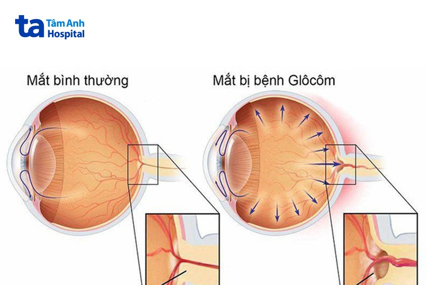 mắt thường và mắt bị glocom