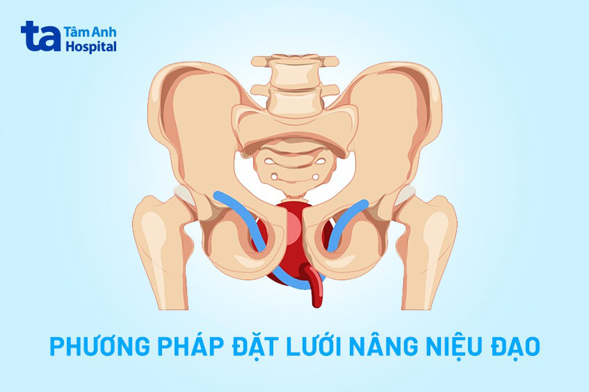 minh họa phẫu thuật đặt lưới nâng niệu đạo