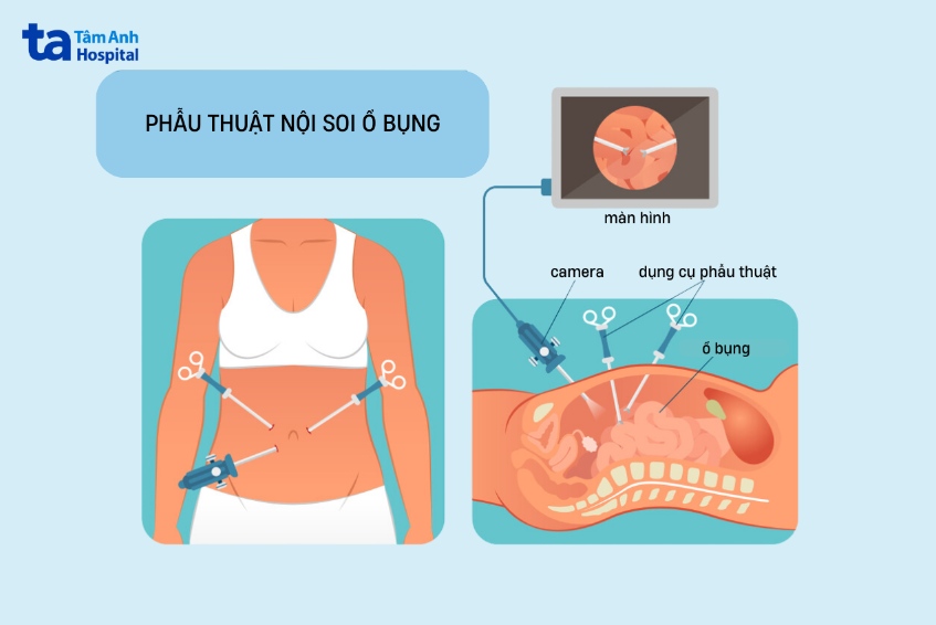 minh họa phẫu thuật nội soi ổ bụng