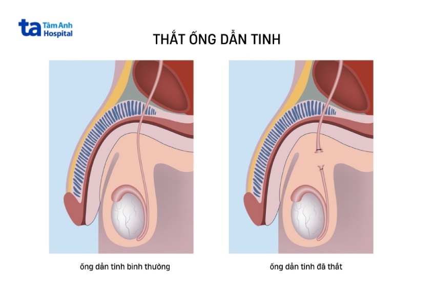 minh họa thắt ống dẫn tinh