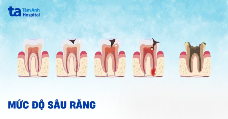 mức độ sâu răng