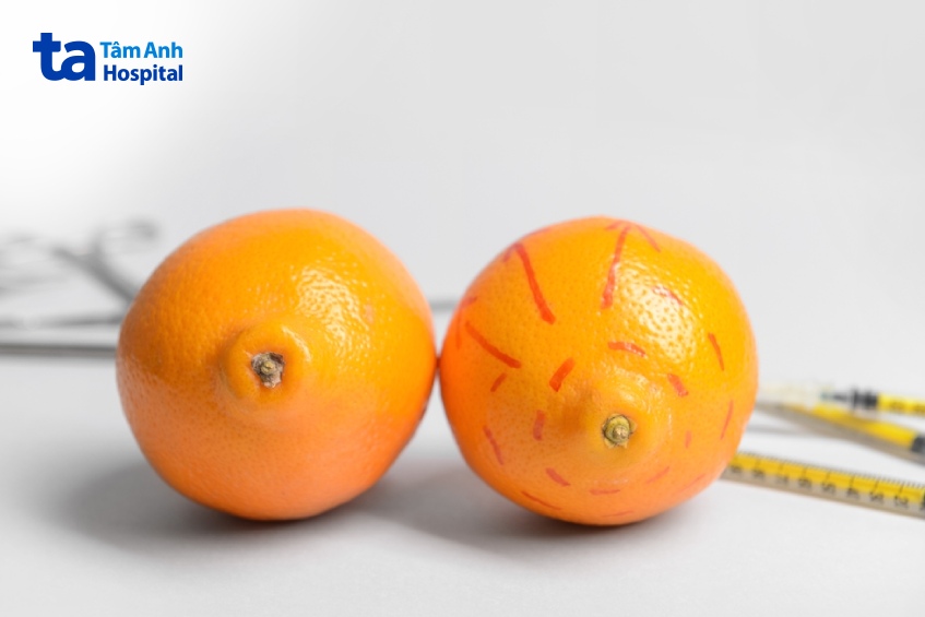 nâng ngực phương pháp lai