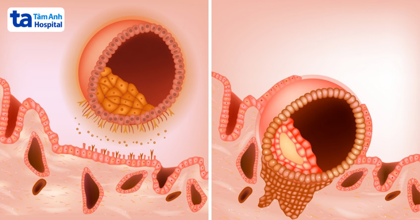 Nếu chuyển đúng vào thời gian mở cửa sổ làm tổ, khả năng cao phôi bám niêm mạc thành công