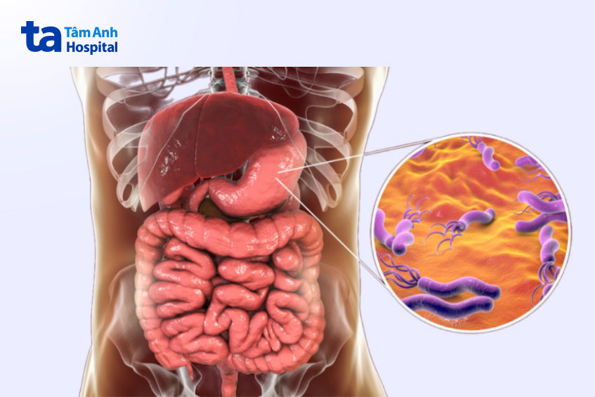 nguyên nhân hàng đầu gây ung thư dạ dày