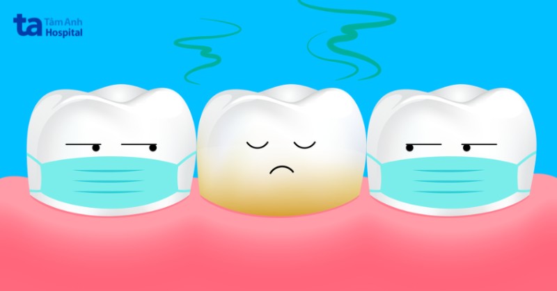 Nguyên nhân gây hôi miệng là gì? Mảng bám do vệ sinh kém