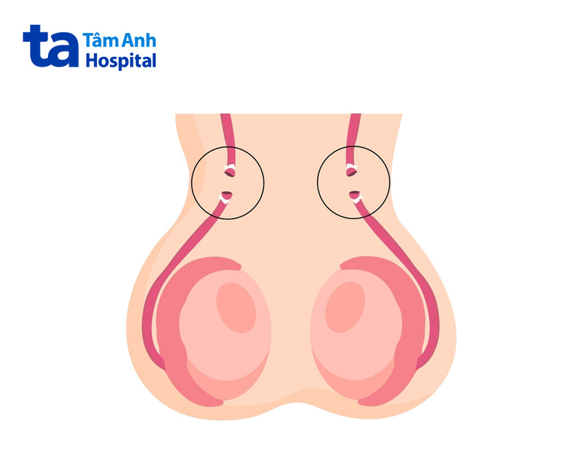 nối ống dẫn tinh