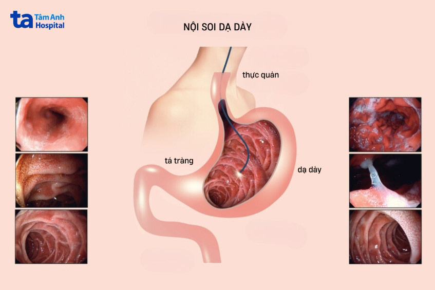 nội soi dạ dày để tầm soát ung thư