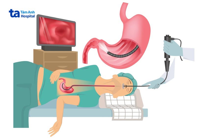 nội soi dạ dày kết hợp sinh thiết