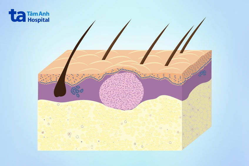 nốt u sợi bì dermatofibroma dưới da