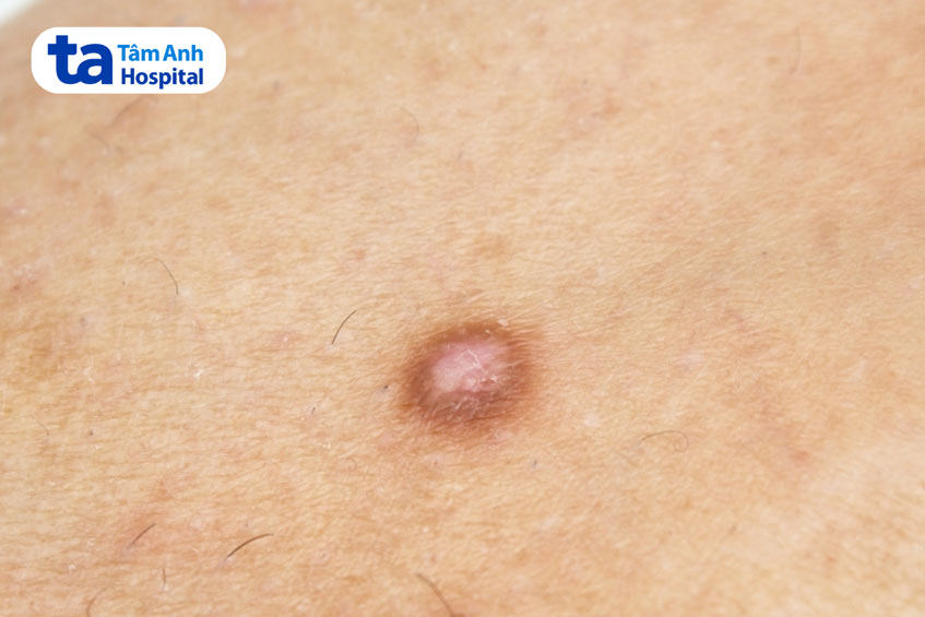 nốt u sợi bì trên da
