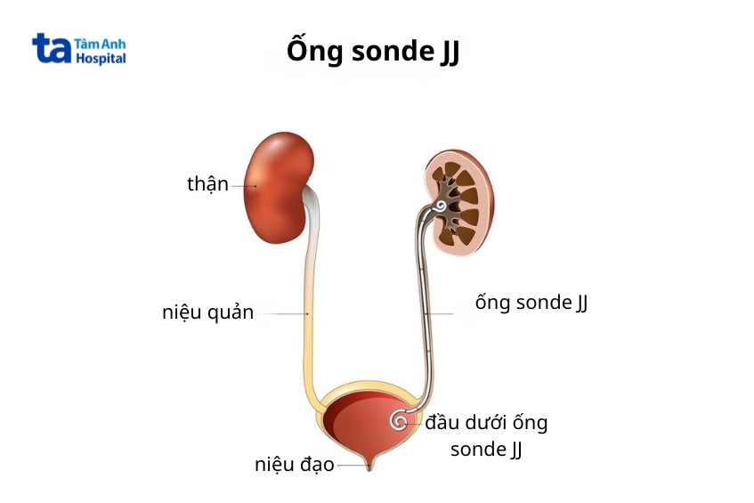 ống sonde jj đặt trong niệu quản