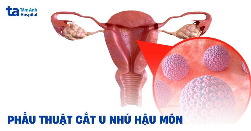 Phẫu thuật cắt u nhú hậu môn: Quy trình thực hiện kỹ thuật