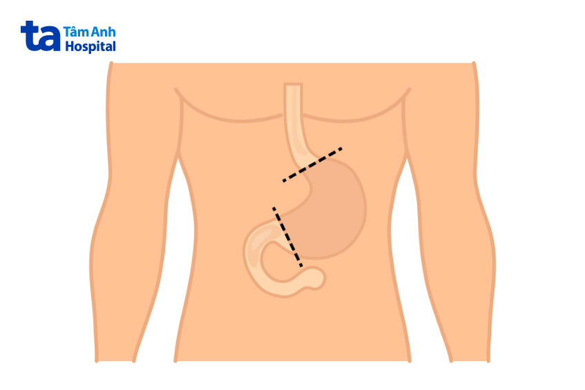 phẫu thuật điều trị triệt căn ung thư dạ dày