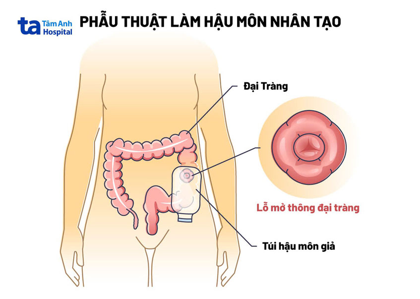 phẫu thuật làm hậu môn nhân tạo cho trẻ