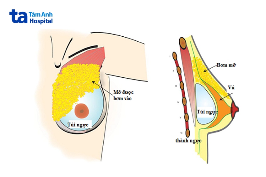 phẫu thuật nâng ngực kết hợp