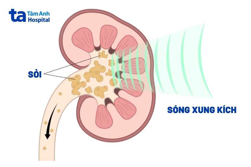 quy trình tán sỏi bằng sóng xung kích