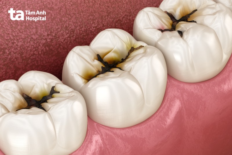 Những bệnh lý răng cấm thường gặp phải