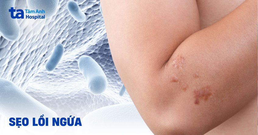 Sẹo lồi ngứa nguyên nhân do đâu? 7 cách xử lý có hiệu quả tức thì