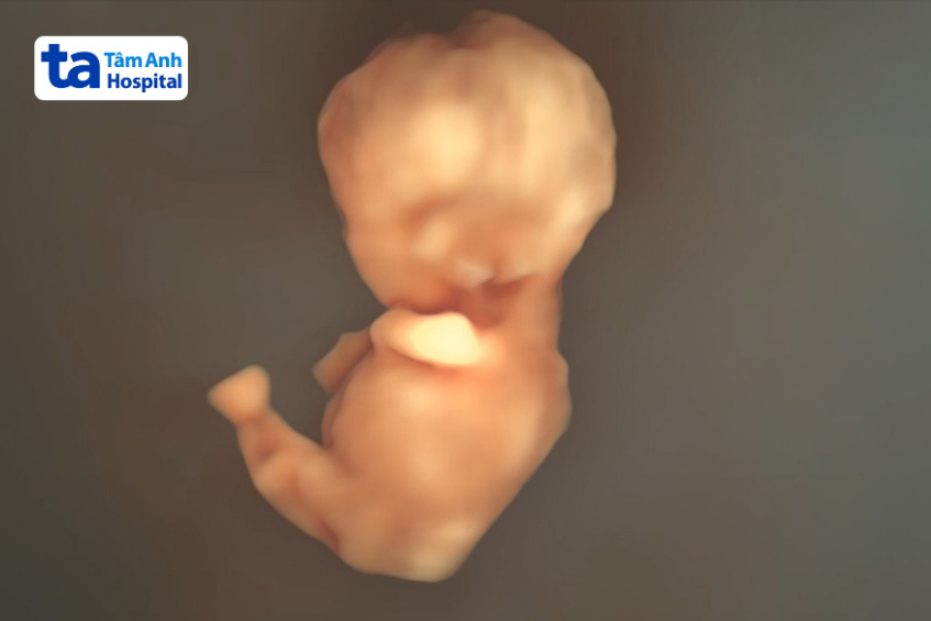 siêu âm ba chiều phát hiện thai nhi mắc hội chứng nàng tiên cá