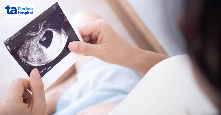 Siêu âm là cách chẩn đoán phổ biến nhằm xác định đã có tim thai hay chưa