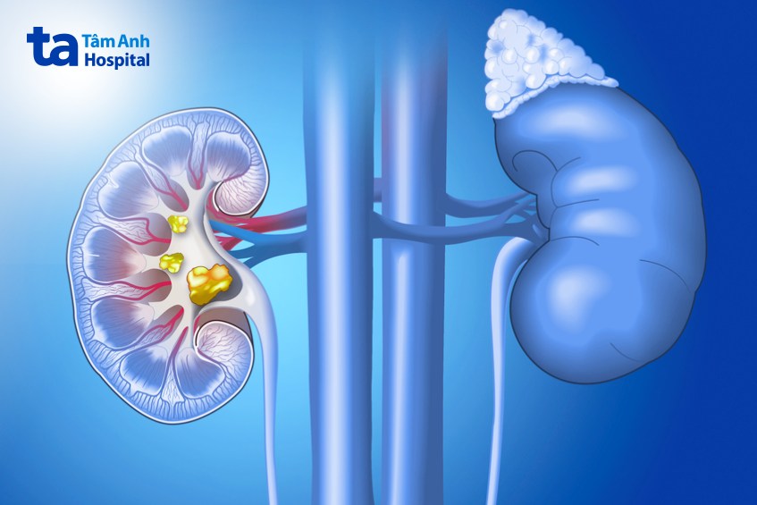 sỏi ở thận và niệu quản