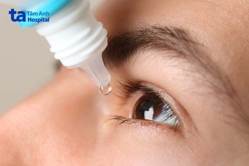 sử dụng thuốc nhỏ mắt giảm viêm và ngứa mắt