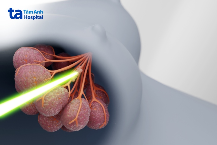 sức khỏe âm đạo sau ung thư vú