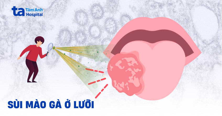 Sùi mào gà ở lưỡi: Nguyên nhân, hình ảnh, dấu hiệu và điều trị