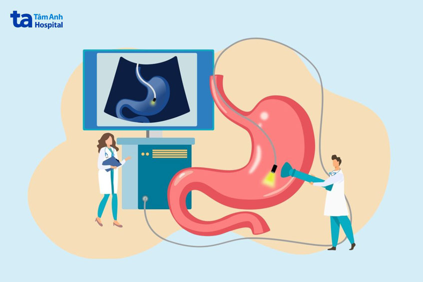 tầm soát ung thư dạ dày giúp phát hiện ung thư ở giai đoạn sớm