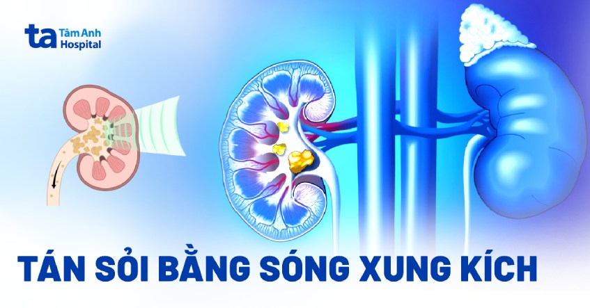 Tán sỏi bằng sóng xung kích là gì?  Chỉ định và chống chỉ định