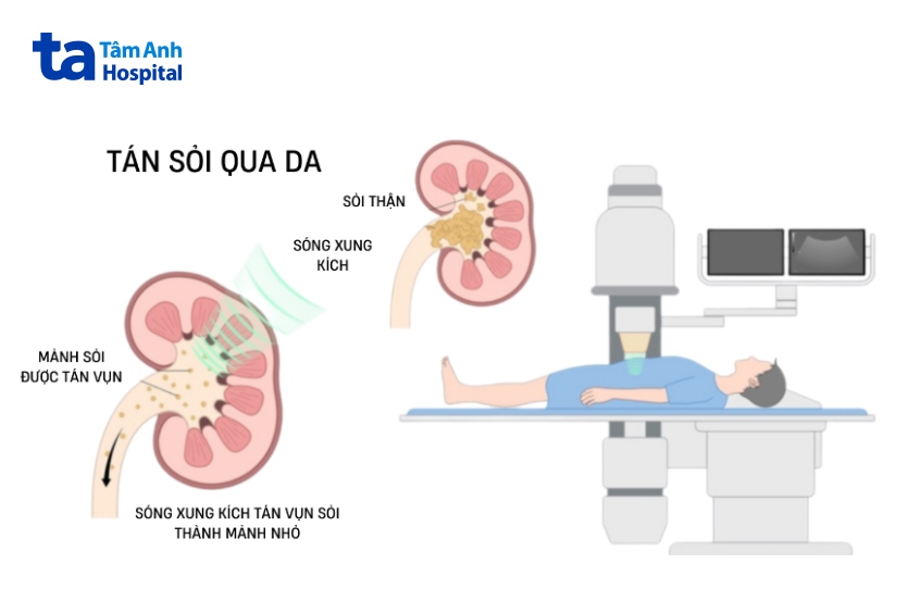 tán sỏi qua da bằng sóng xung kích