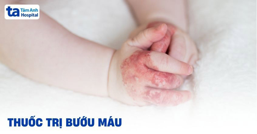 5 thuốc trị bướu máu được chuyên gia tư vấn sử dụng [Tham Khảo]