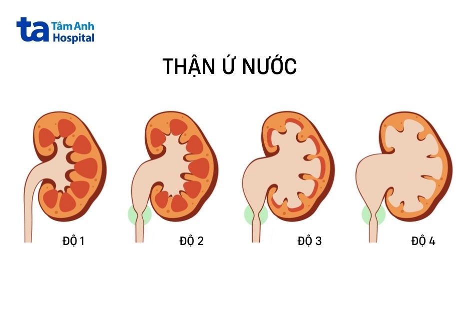 tình trạng thận ứ nước tiến triển ra sao