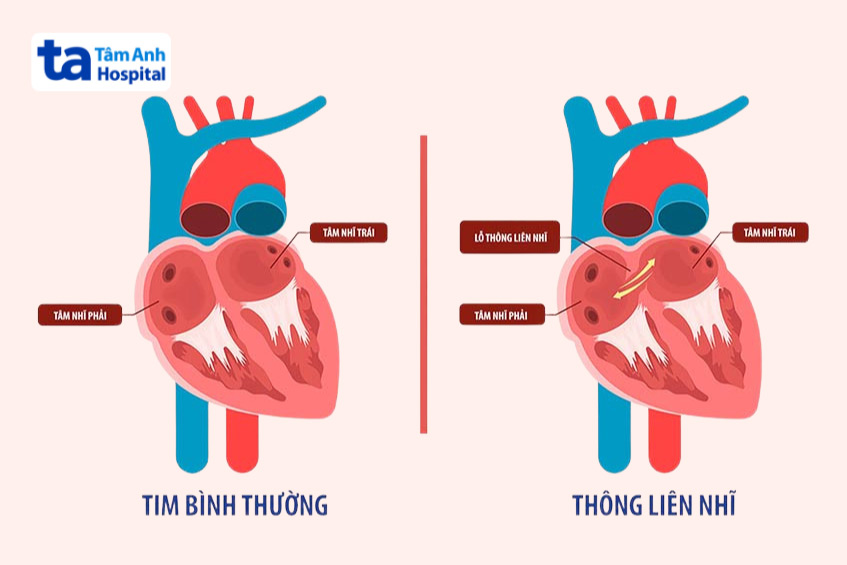 Hình ảnh tim bình thường và tim bị thông liên nhĩ ở trẻ