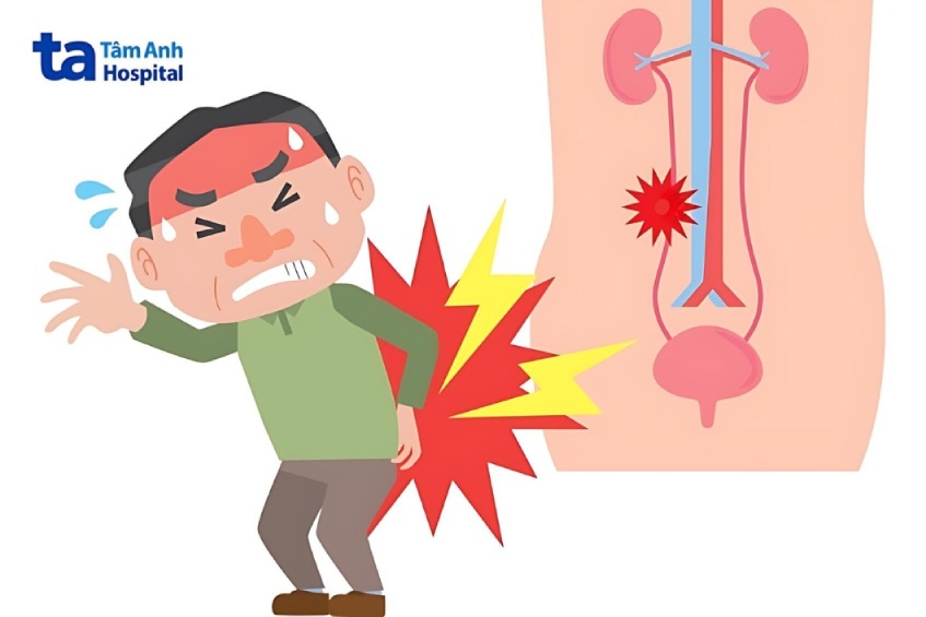 triệu chứng hẹp niệu quản