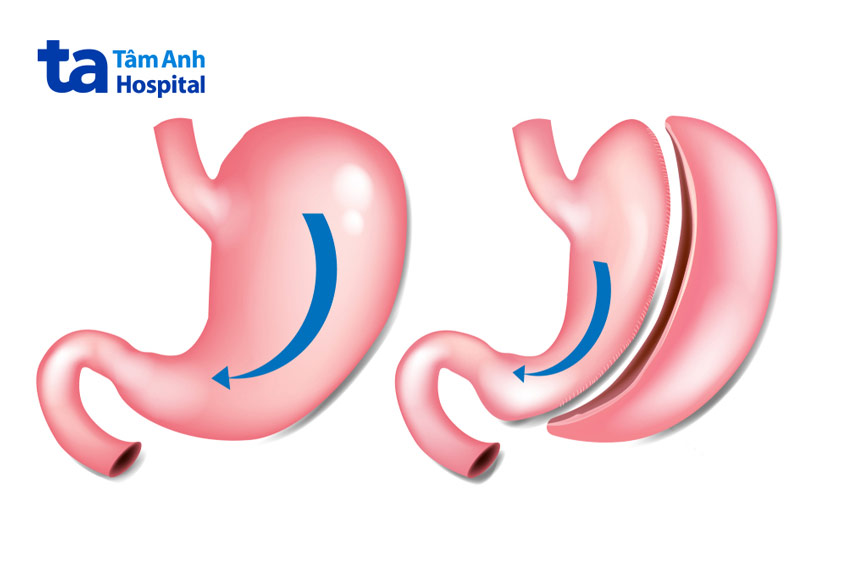 trước và sau phẫu thuật cắt dạ dày một phần