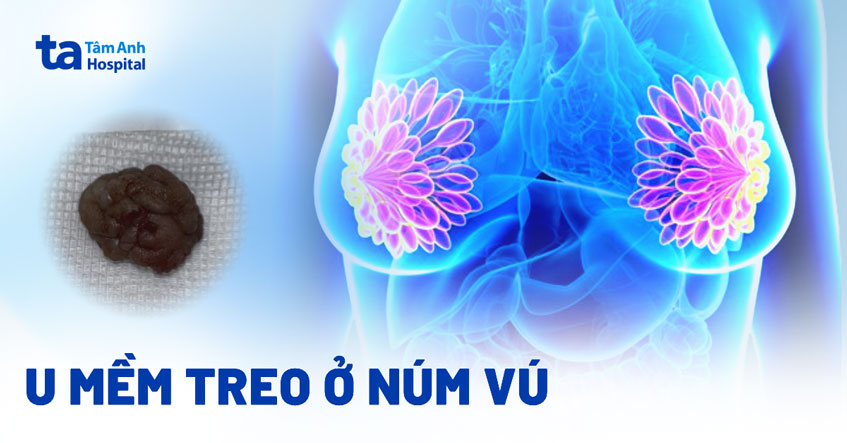 u mềm treo ở núm vú