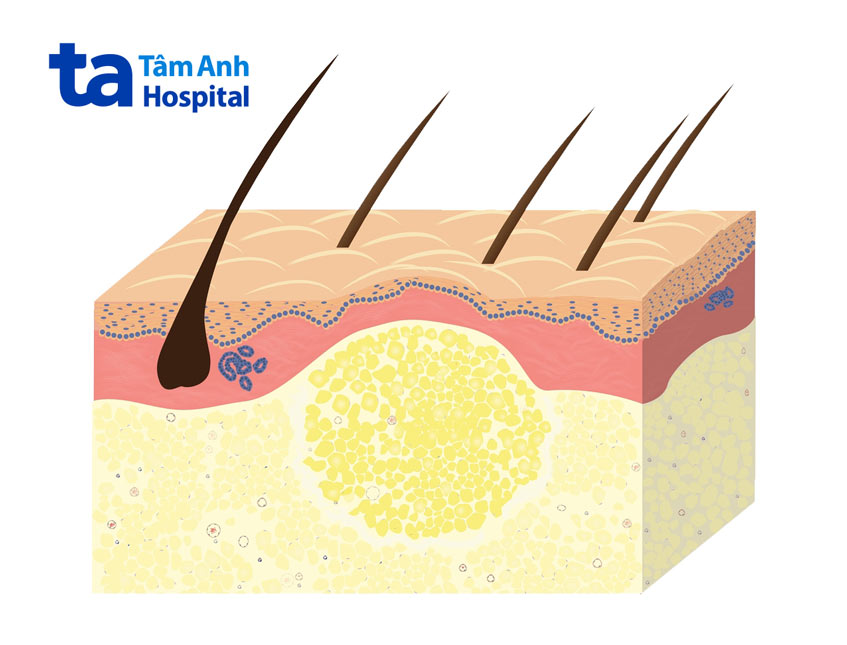 u mỡ có thể là nguyên nhân