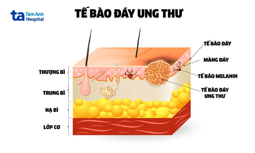 ung thư biểu mô mô tế bào đáy