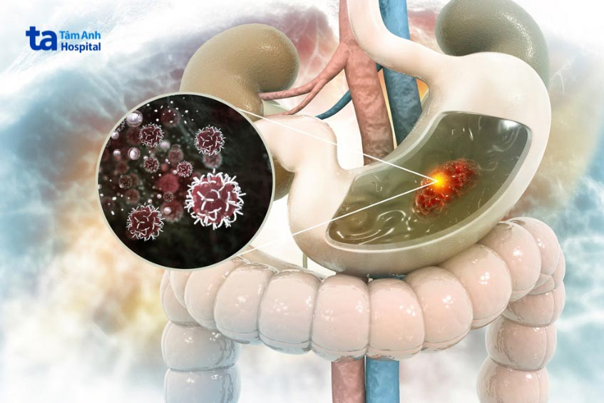 ung thư dạ dày giai đoạn 1 chưa xâm lấn qua lớp niêm mạc dạ dày