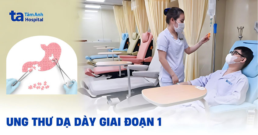 Ung thư dạ dày giai đoạn 1: Dấu hiệu, chẩn đoán và cách điều trị