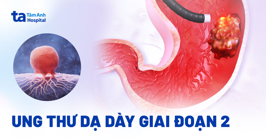 Ung thư dạ dày giai đoạn 2: Dấu hiệu, chẩn đoán và cách điều trị
