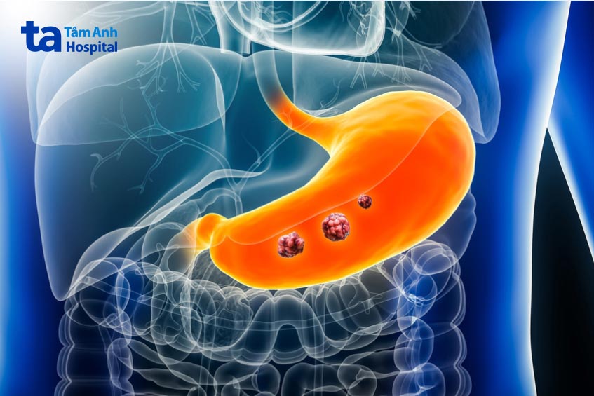 ung thư dạ dày giai đoạn sớm